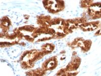 FFPE human prostate carcinoma sections stained with 100 ul anti-TAG-72 / CA72.4 (clone B72.3) at 1:100. HIER epitope retrieval prior to staining was performed in 10mM Citrate, pH 6.0.